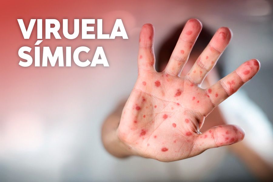 MORÓN: SE DETECTÓ UN CASO DE MPOX EN EL HOSPITAL DE MORÓN